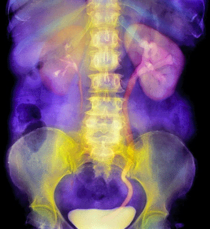 Image: Colored urogram of a patient’s abdomen showing a blocked ureter due to a kidney stone (Photo courtesy of SPL).